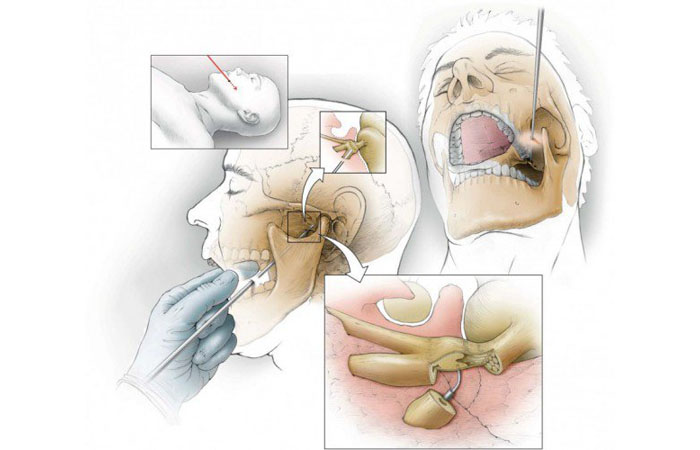 Воспаление тройничного нерва Воспаление тройничного нерва