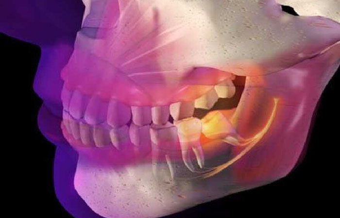 Абсцесс зуба Абсцесс зуба