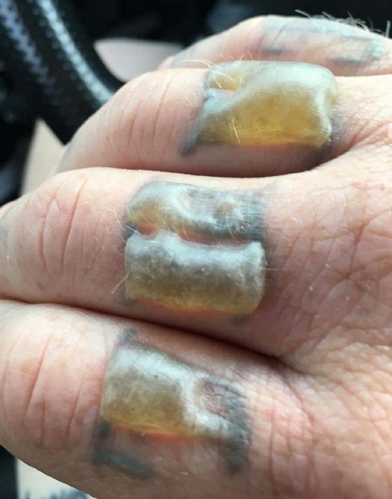 Обожженные пальцы во время лазерного удаления татуировки.