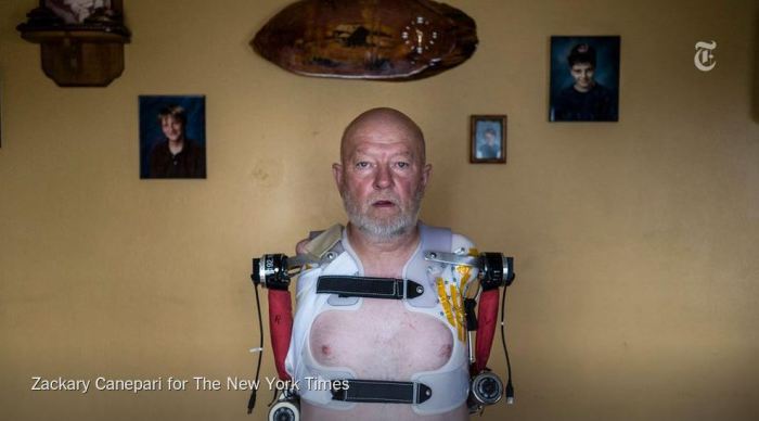 Протезы на корсете. Протезы на корсете.