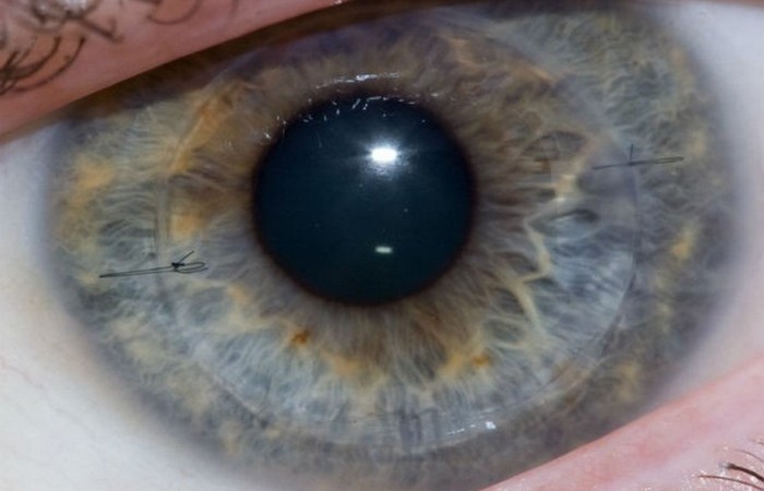 Глазные имплантаты, которые делают слепых зрячими.