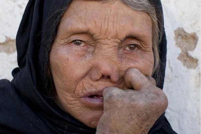 Проказа. Проказа.