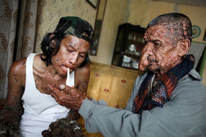 Бородавчатая эпидермодисплазия. Бородавчатая эпидермодисплазия.