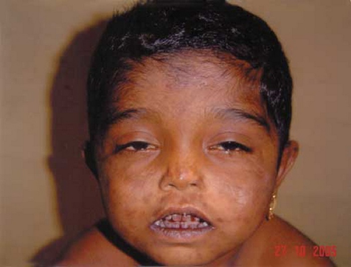 Порфирия. Порфирия.