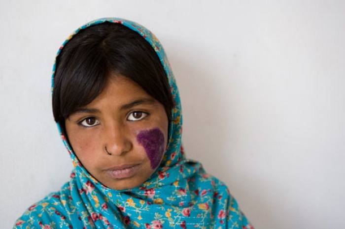 Кожный лейшманиоз. Кожный лейшманиоз.