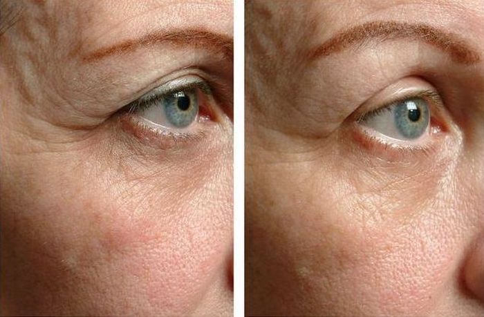 Инъекции коллагена человеческого происхождения. Инъекции коллагена человеческого происхождения.