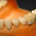 Создан зуб-шпион: ученые встроили в протез Wi-Fi и Bluetooth