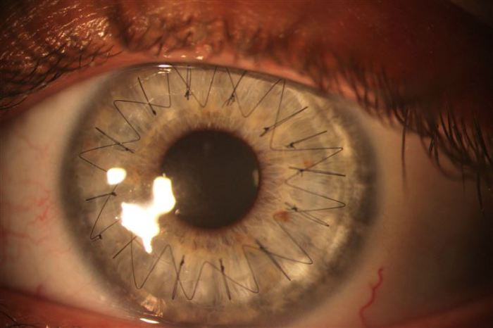 Швы, наложенные во время пересадки роговой оболочки глаза.